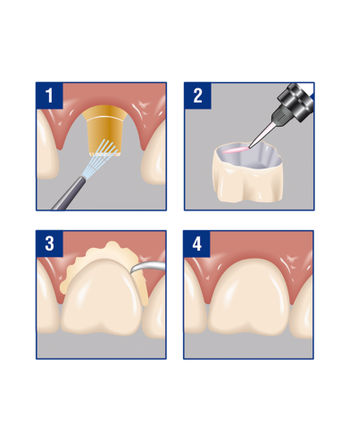 Цемент для імплантів, коронок, мостових конструкцій DSI Semi-Permament Implant Cement, 1 шприц 8,6 г + 10 насадок.