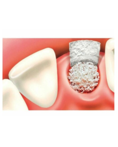 Синтетичний кістковий матерал (трансплантат) DSI Syntoss Bone Graft, Гранули (500-1000 мкм) , 1,0 см3