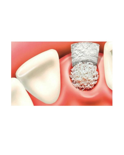 Натуральний кістковий матеріал (ксенотрансплантат) DSI Zenoss Bone Graft, Гранули (200-1000 мкм), 0.25 см3